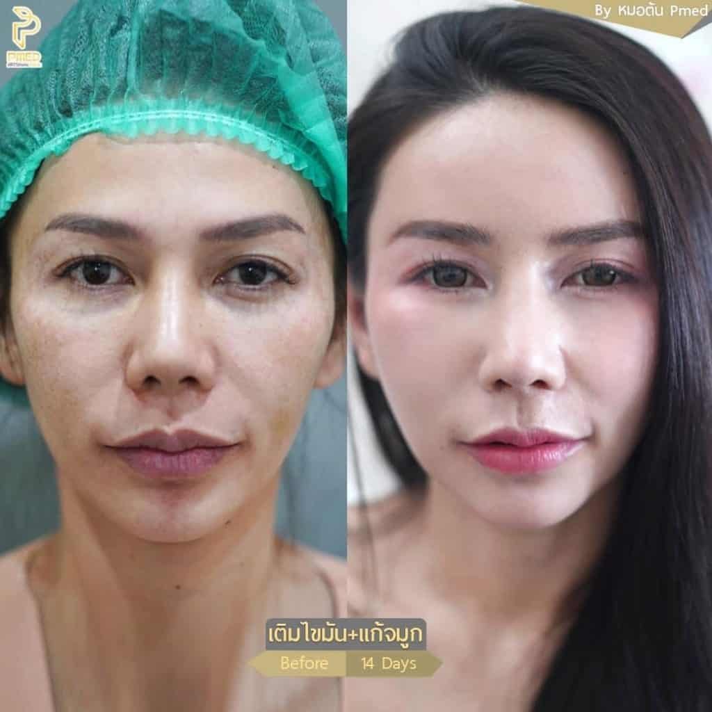 เจาะลึกไทม์ไลน์การฟื้นตัวหลังฉีดไขมันหน้าผาก ต้องใช้เวลากี่วันถึงเข้าที่? กี่เดือนถึงเห็นผล? 3 เจาะลึกไทม์ไลน์การฟื้นตัวหลังฉีดไขมันหน้าผาก ต้องใช้เวลากี่วันถึงเข้าที่? กี่เดือนถึงเห็นผล?