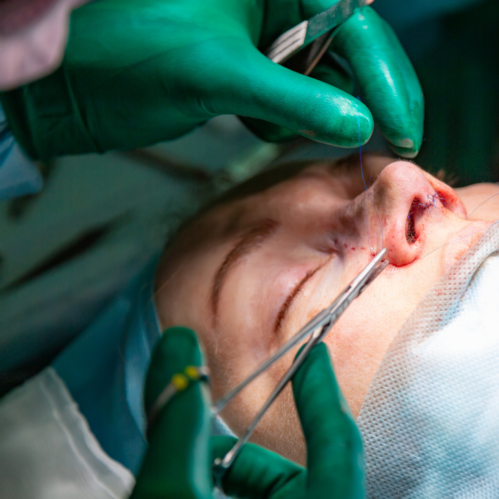 4 เทคนิคหลักที่ใช้ในการแก้จมูกแบบโอเพ่น (Open Revision Rhinoplasty) 5 เทคนิคหลักที่ใช้ในการแก้จมูกแบบโอเพ่น (Open Revision Rhinoplasty)