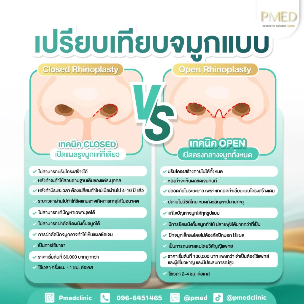 รูปแบบการเสริมจมูกแต่ละประเภท เลือกแบบไหนเหมาะกับคุณที่สุด?