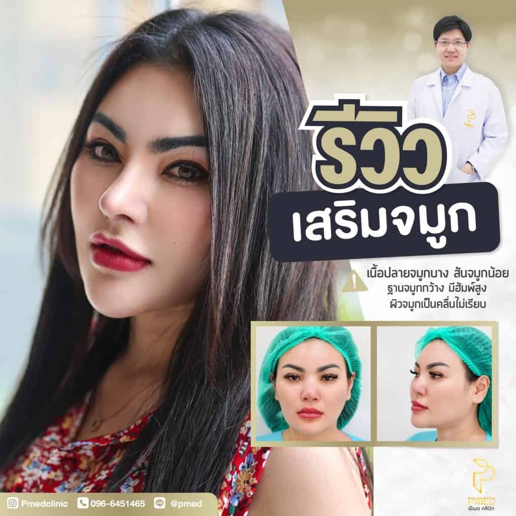 ข้อดีของการเสริมจมูกแบบโอเพ่น เทคนิคที่ให้ผลลัพธ์แม่นยำและเป็นธรรมชาติ 3 ข้อดีของการเสริมจมูกแบบโอเพ่น เทคนิคที่ให้ผลลัพธ์แม่นยำและเป็นธรรมชาติ