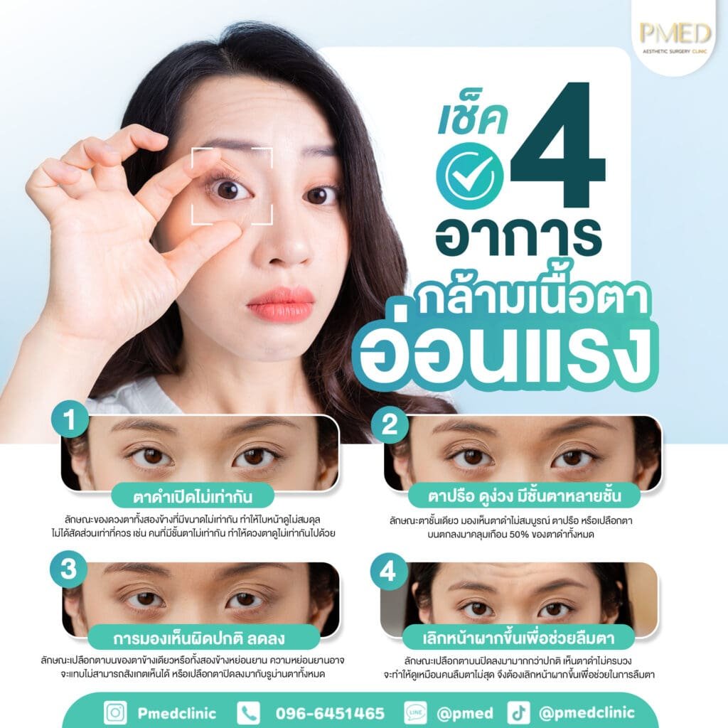4อาการกล้ามเนื้อตา TH PMED