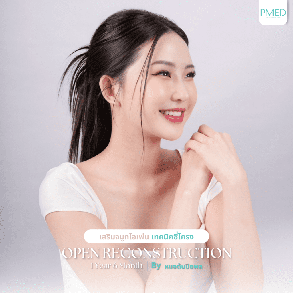 การเปรียบเทียบระหว่างเสริมจมูกไร้ซิลิโคนและเสริมจมูกด้วยซิลิโคน