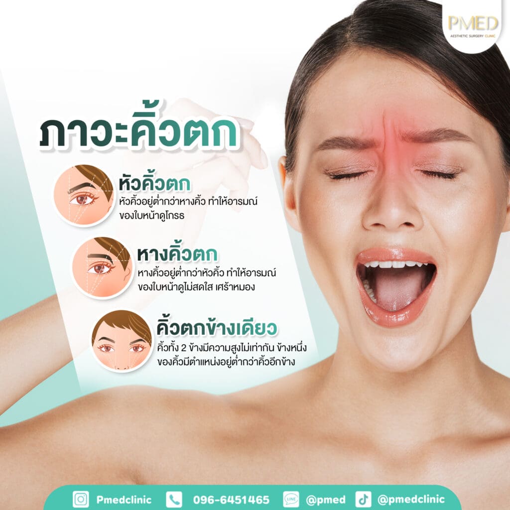 Brow Lift 12 ภาวะคิ้วตก TH PMED