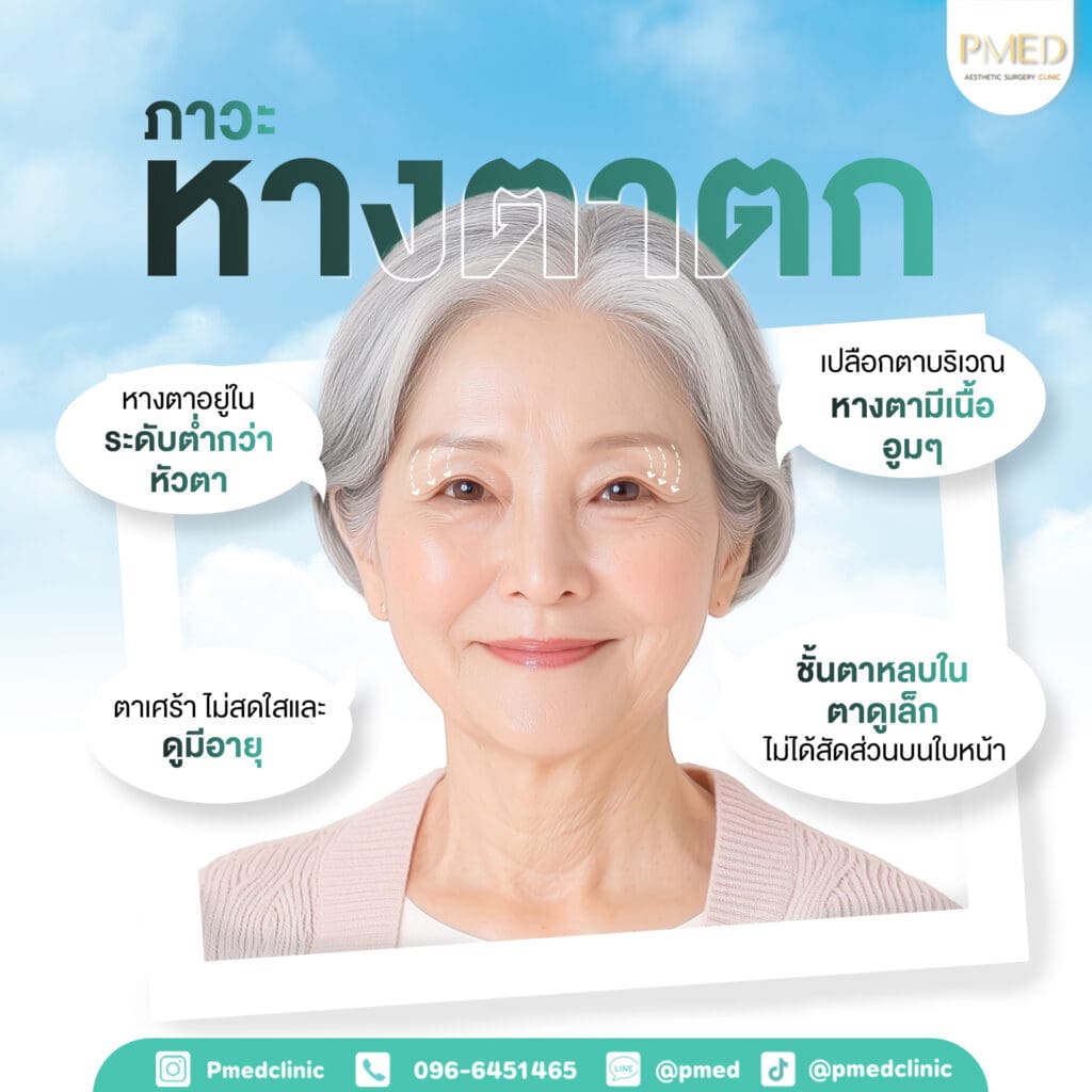 Brow Lift 23 ภาวะหางตาตก TH PMED