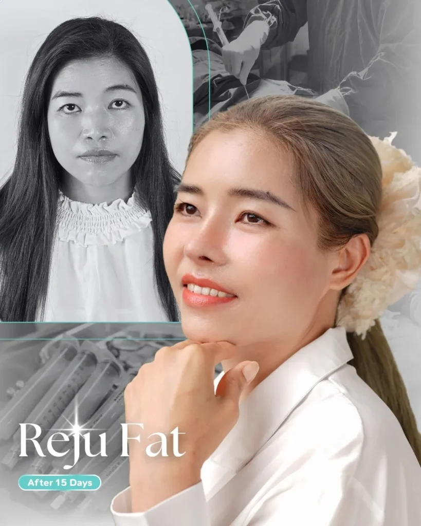 รีวิวเติมไขมันหมอต้น10