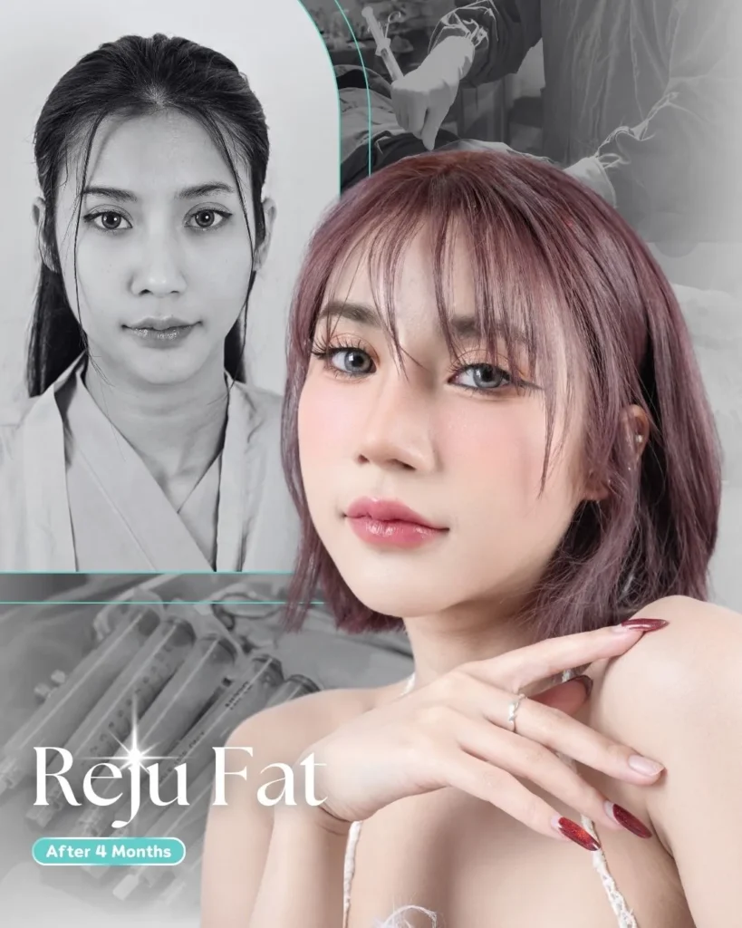 ที่พีเมดคลินิกจะใช้ Growth Factor ในการฉีดไขมันหน้า