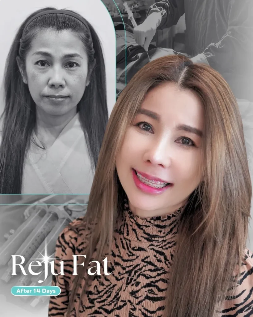 รีวิวเติมไขมันหมอต้น