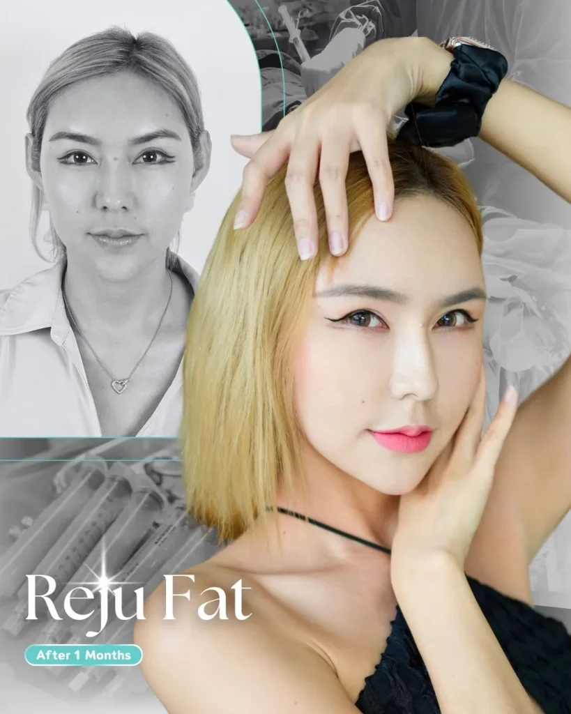 รีวิวเติมไขมันหมอต้น3