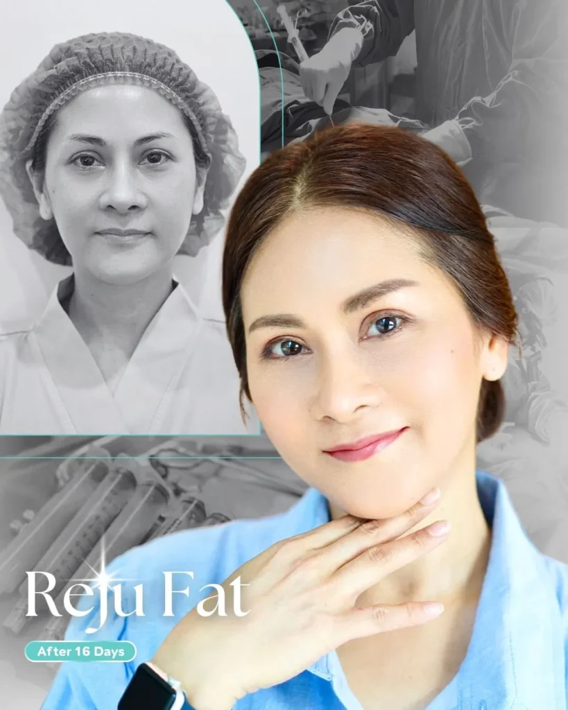 รีวิวเติมไขมันหมอต้น4