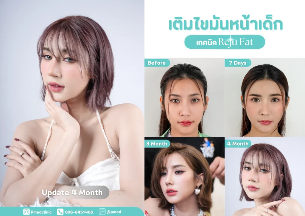 เติมไขมันหลังดึงหน้าแก้ปัญหาผิวหย่อนคล้อยในวัย 50 ปีขึ้นไป คืนความอ่อนเยาว์อย่างเป็นธรรมชาติ