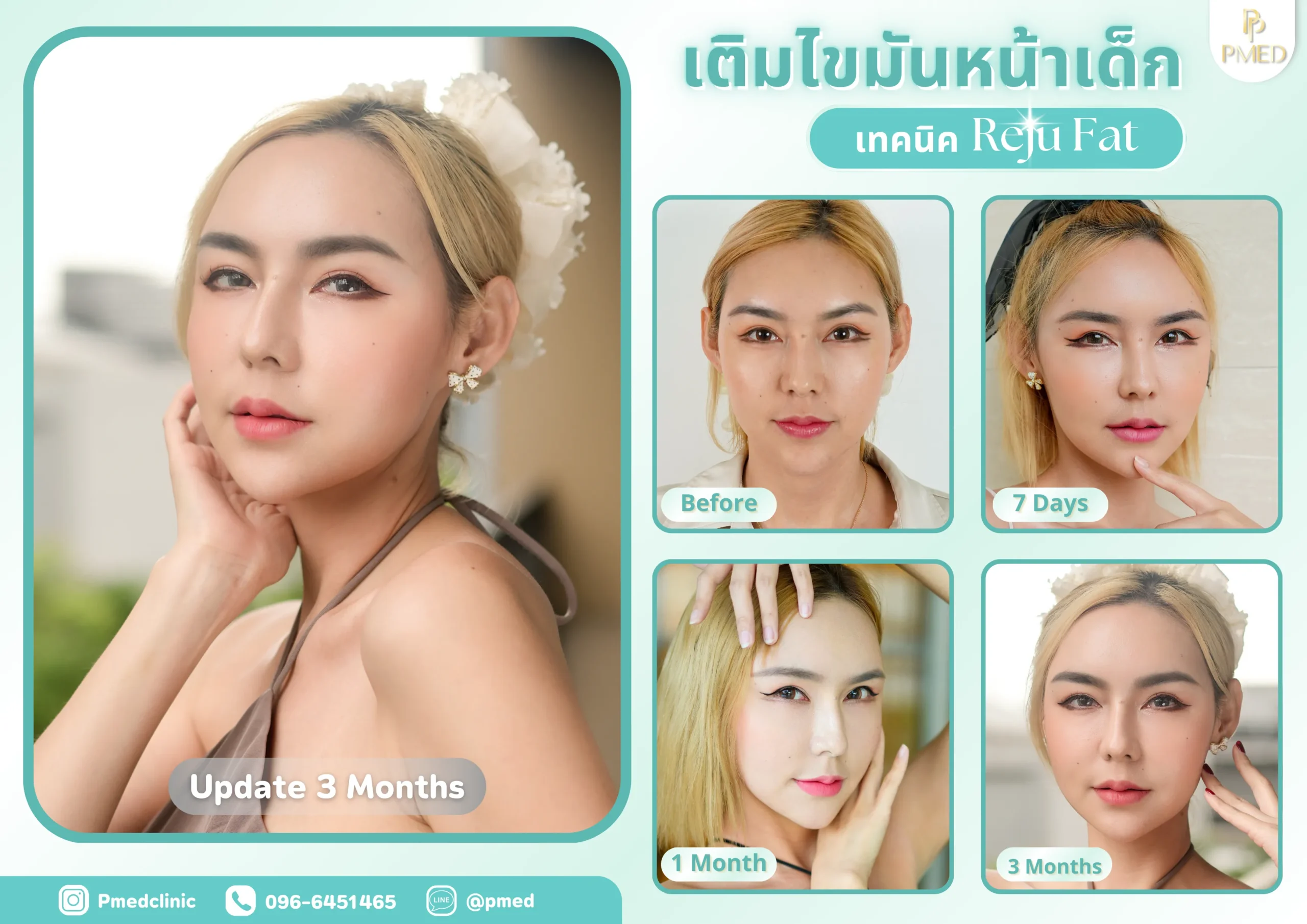 Landing page 39 เติมไขมันปรับรูปหน้า (4) (1)