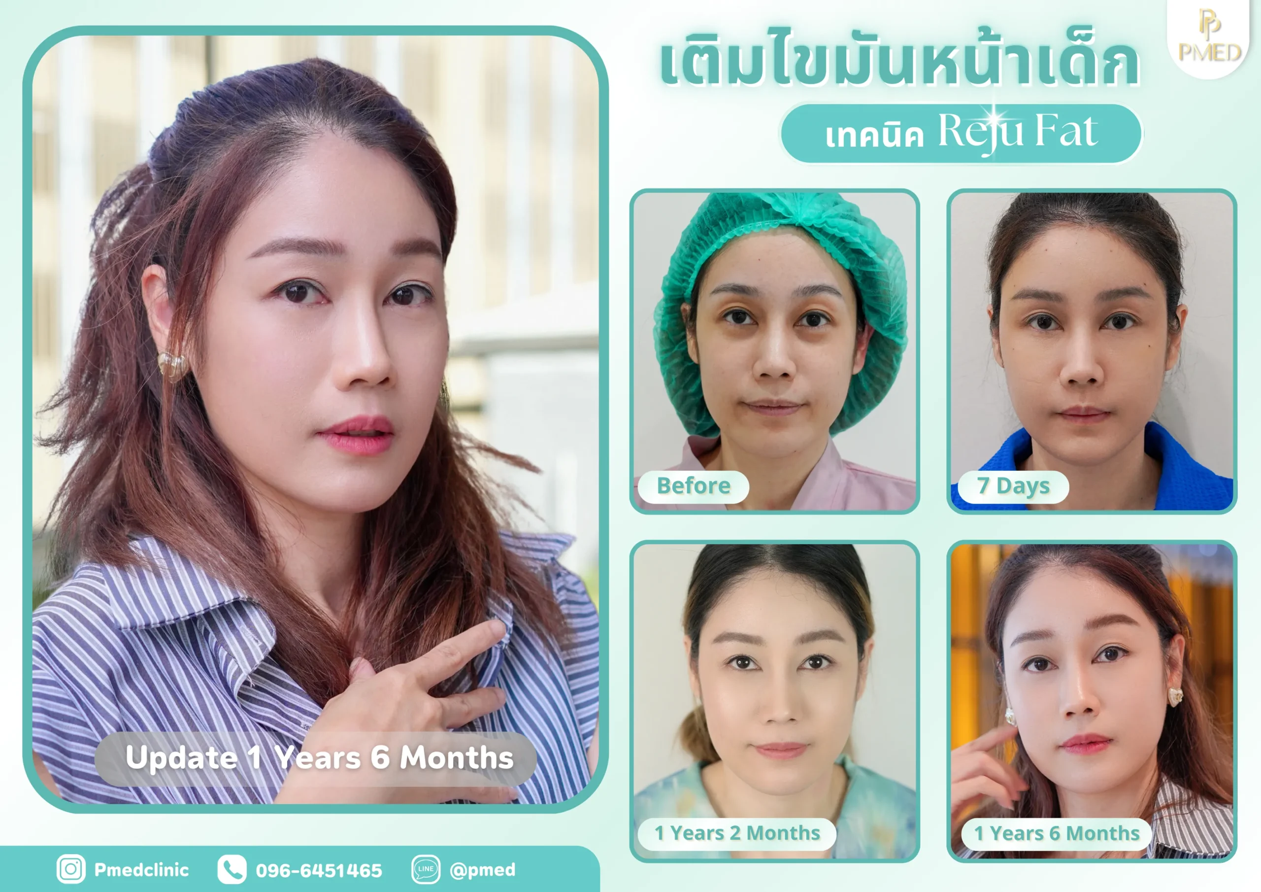 Landing page 40 เติมไขมันปรับรูปหน้า (5) (1)