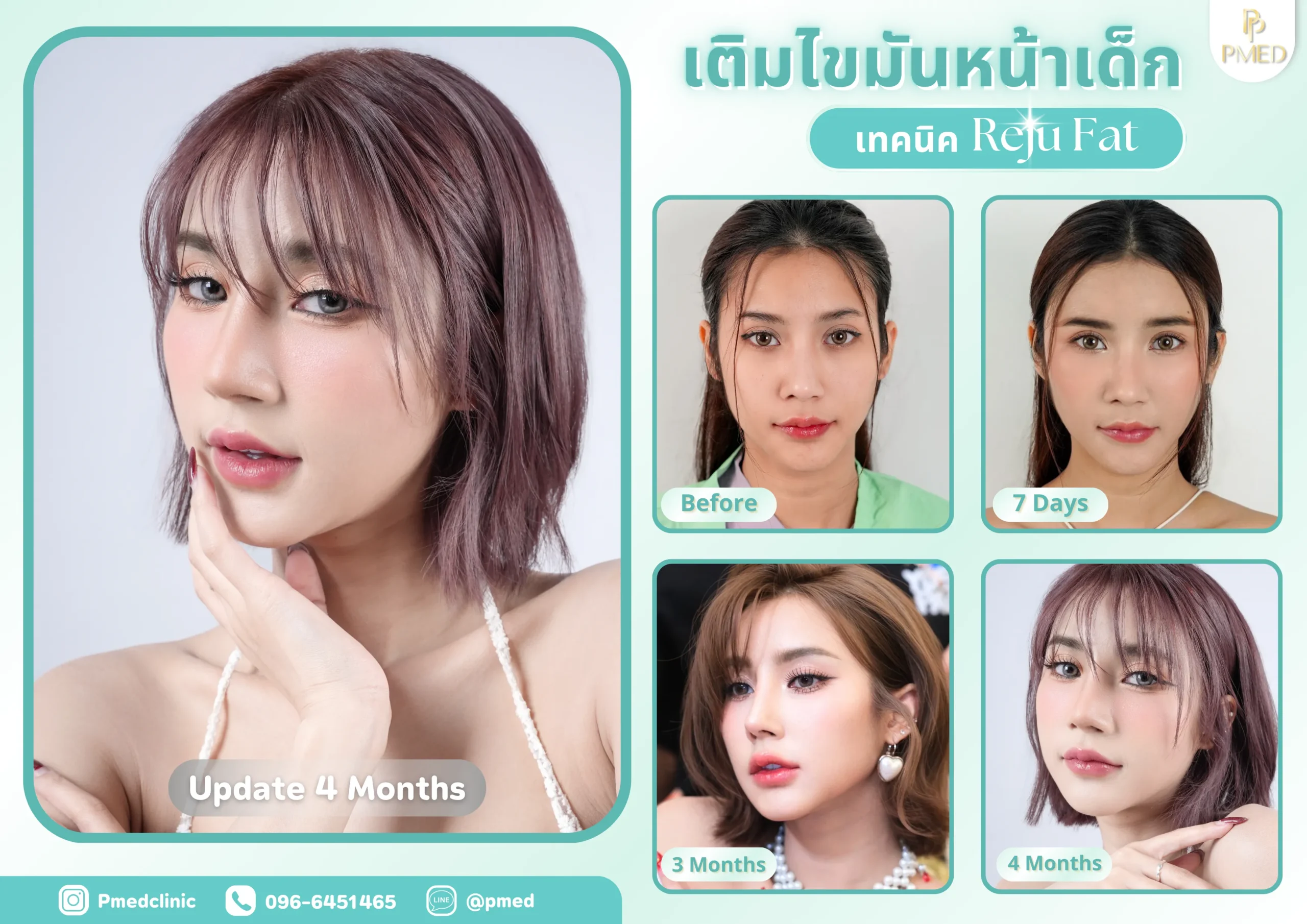 Landing page 38 เติมไขมันปรับรูปหน้า (6) (1)