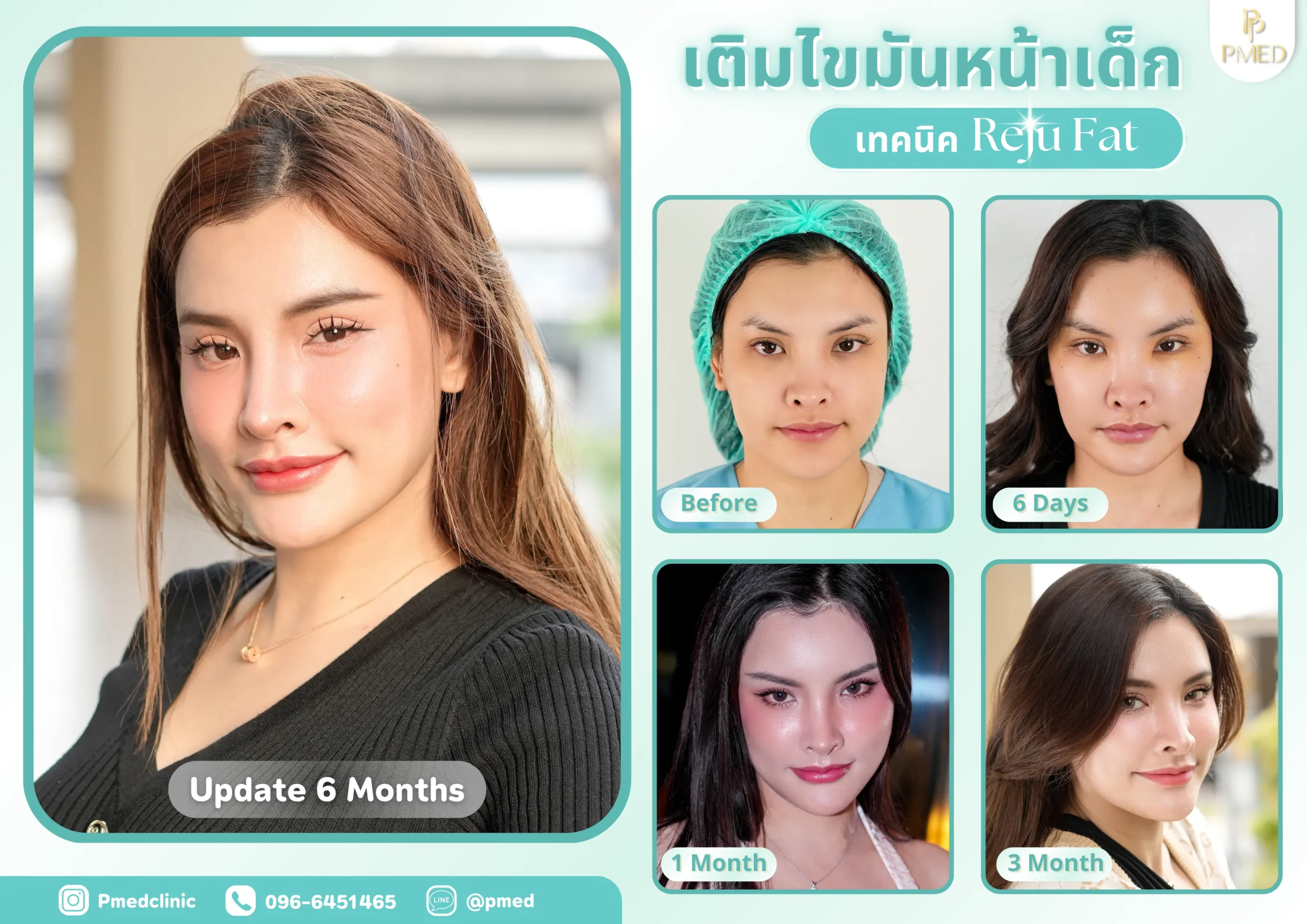 Landing page 37 เติมไขมันปรับรูปหน้า (7) (1)