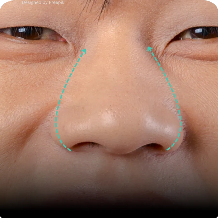 เทคนิคการตัดปีกจมูก ปรับรูปทรงจมูกให้สมดุลอย่างเป็นธรรมชาติ