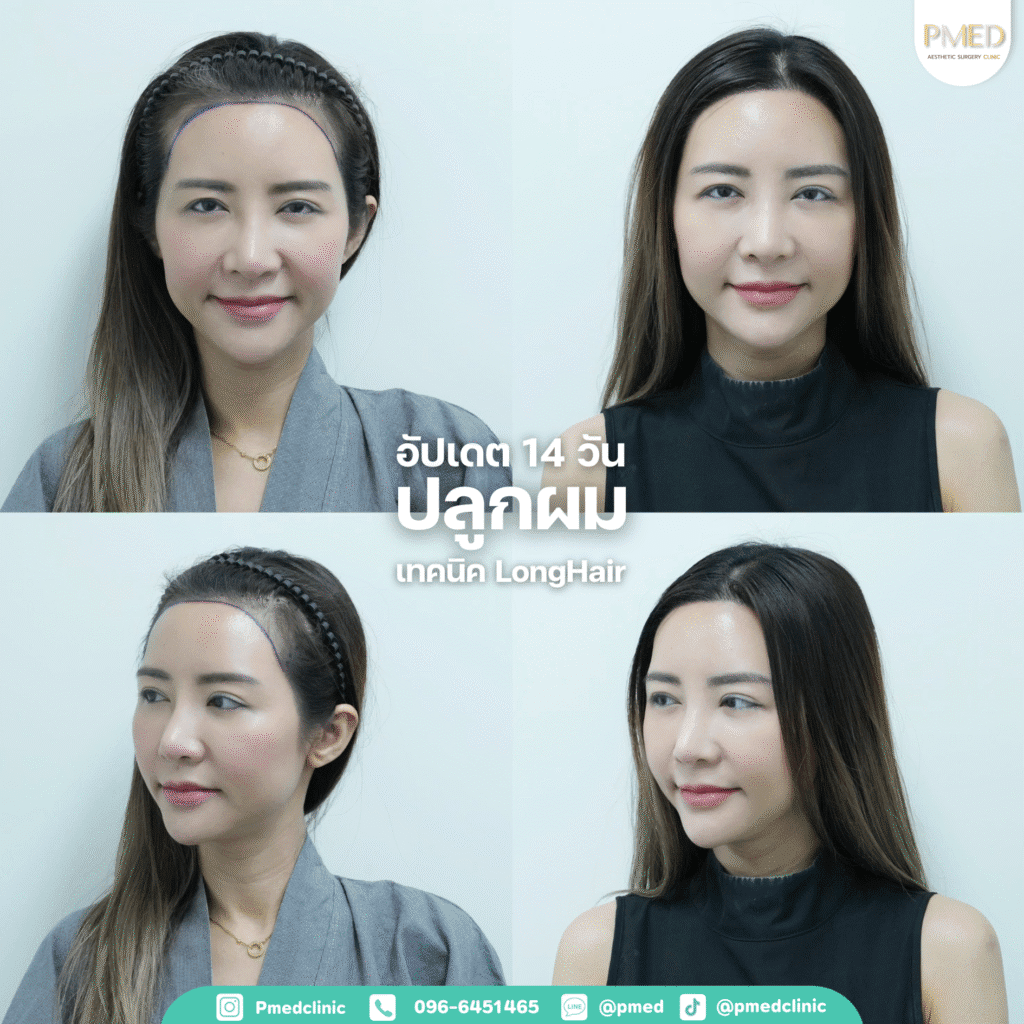 รีวิวปลูกผม42G