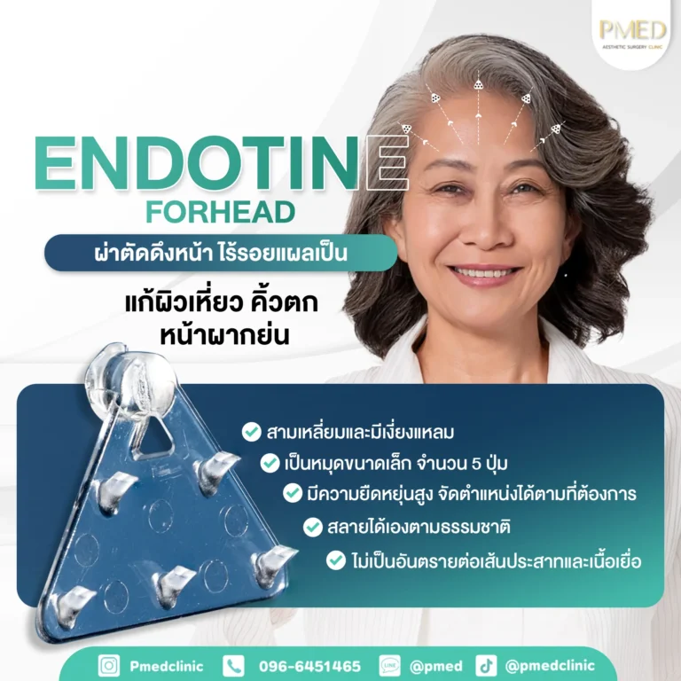 Endotine-TH-PMED_11zon