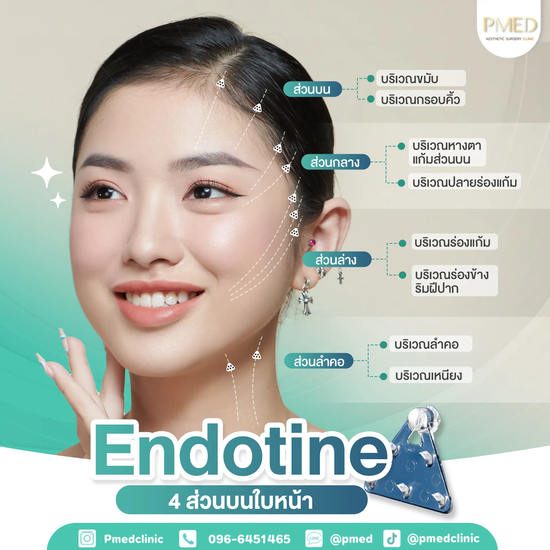 Endotine 4 Endotine4 TH 11zon