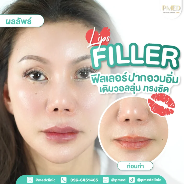 รีวิวฉีดฟิลเลอร์พีเมด1
