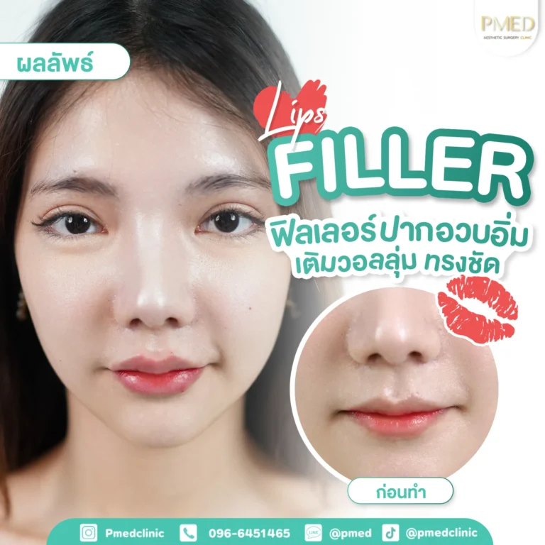 รีวิวฉีดฟิลเลอร์พีเมด2
