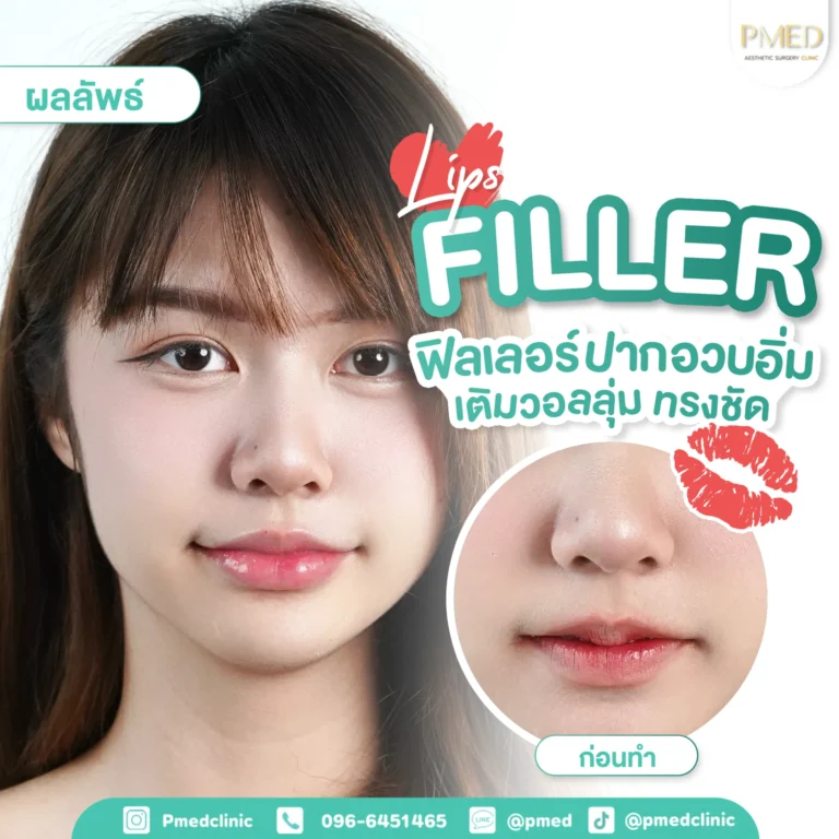 รีวิวฉีดฟิลเลอร์พีเมด3