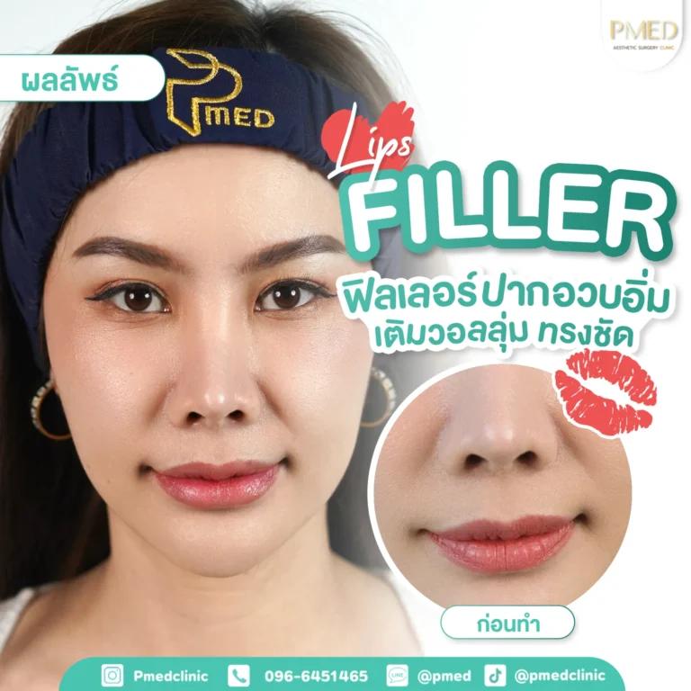 รีวิวฉีดฟิลเลอร์พีเมด5