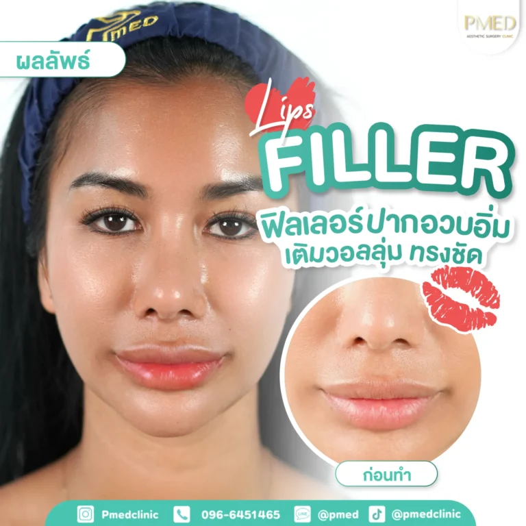 รีวิวฉีดฟิลเลอร์พีเมด6
