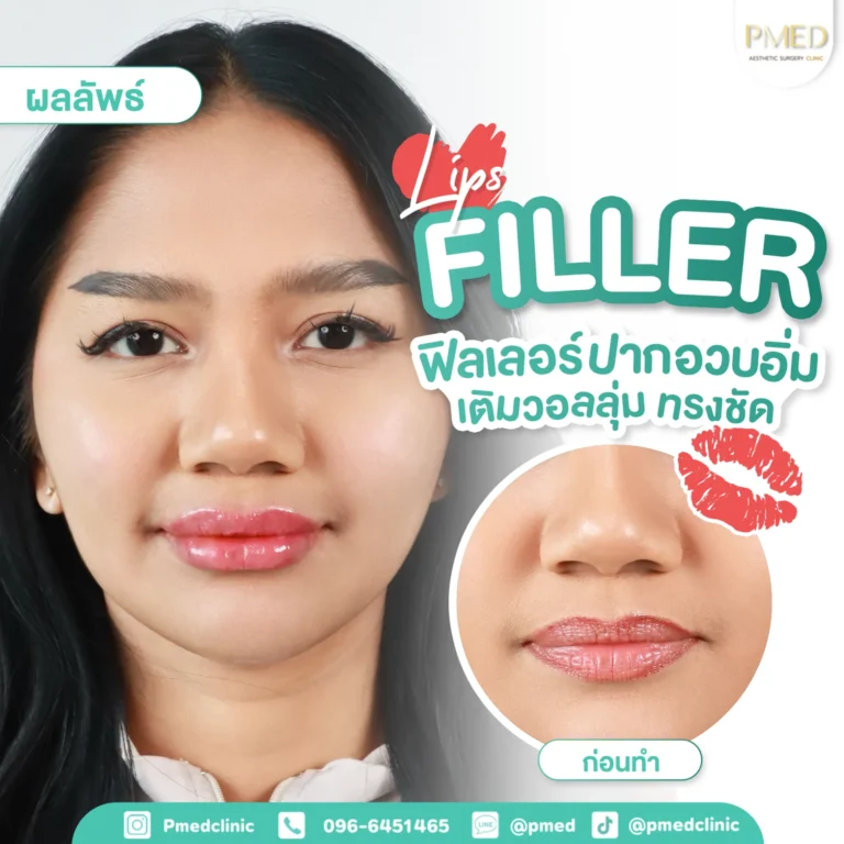 รีวิวฉีดฟิลเลอร์พีเมด7