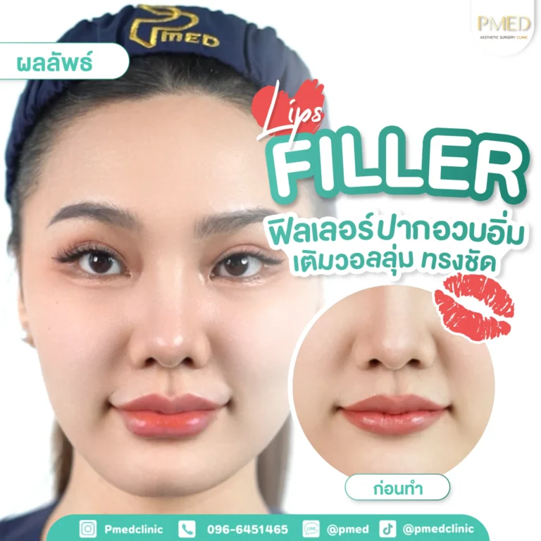รีวิวฉีดฟิลเลอร์พีเมด8
