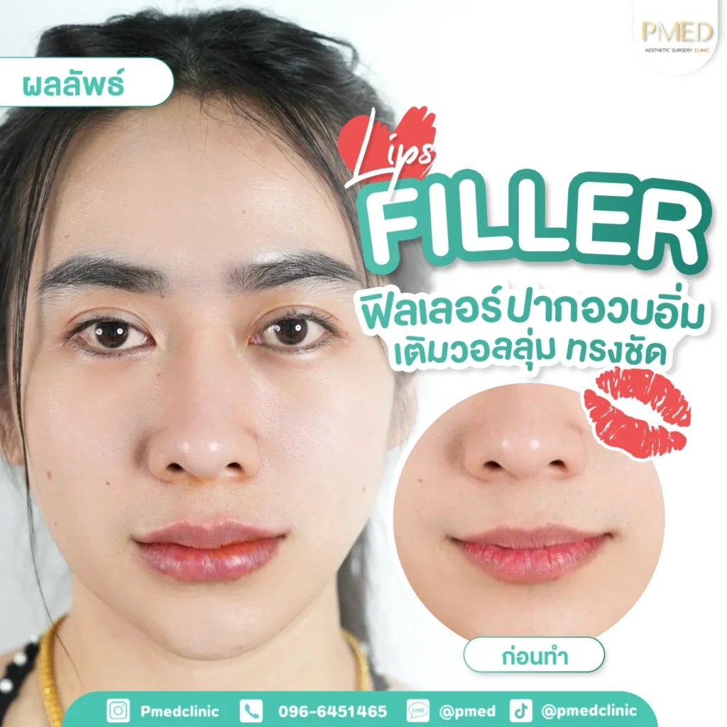ปัญหาการฉีดฟิลเลอร์แล้วเป็นก้อน พร้อมตำแหน่งที่พบบ่อย