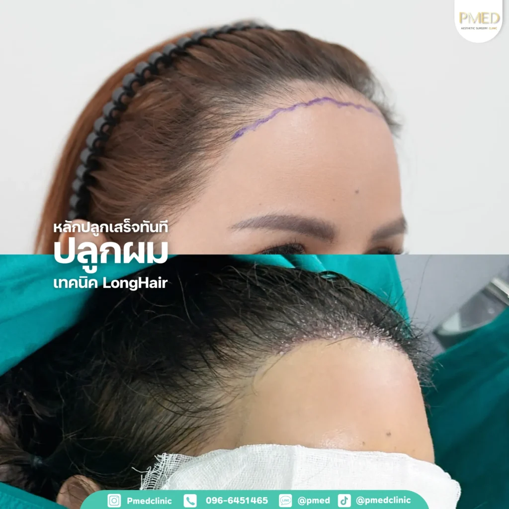 การปลูกผมคืออะไร? คู่มือฉบับเต็มสำหรับผู้มีปัญหาผมบาง ศีรษะล้าน