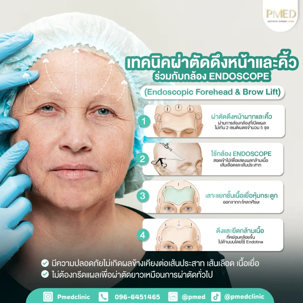 Endotine 7 เทคนิคดึงหน้า TH PMED