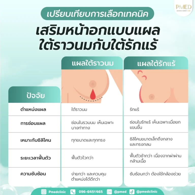 เสริมหน้าอก 8 เสริมหน้าอกพีเมดคลินิก 1