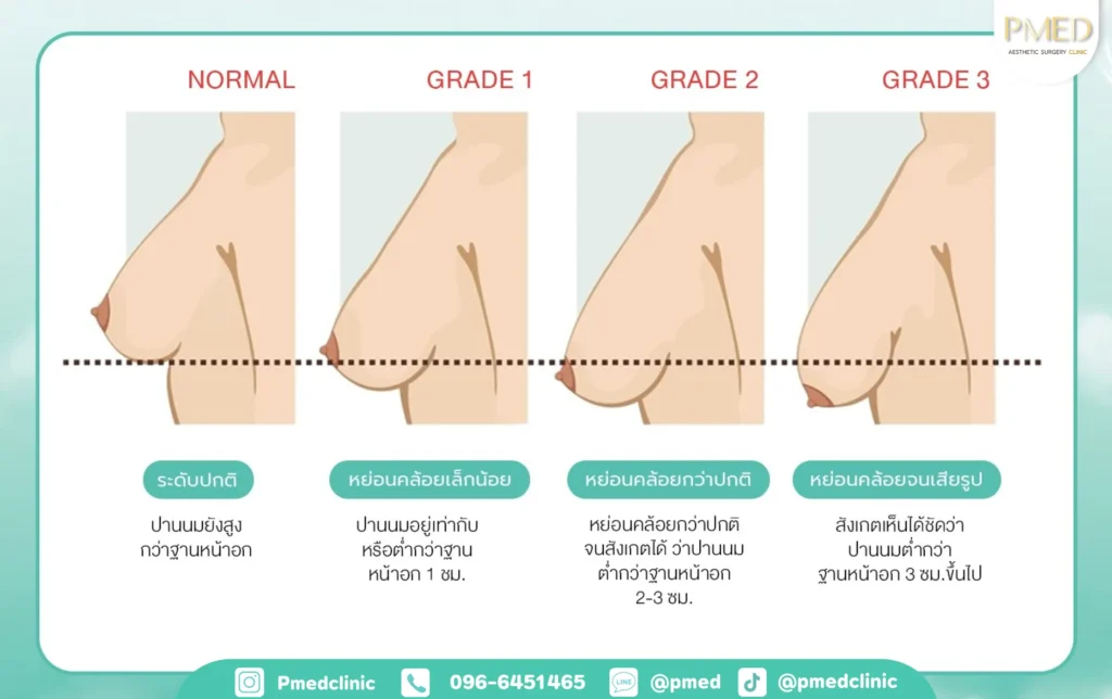 เสริมหน้าอก 9 เสริมหน้าอกพีเมดคลินิก 2