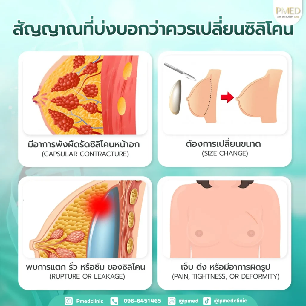 เสริมหน้าอก 10 เสริมหน้าอกพีเมดคลินิก 4