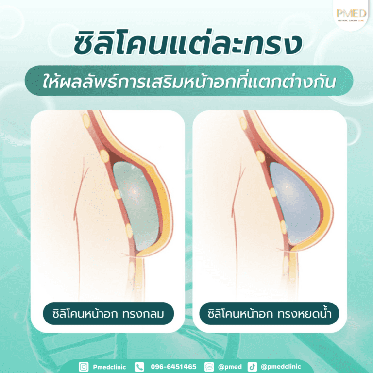 เสริมหน้าอก 7 เสริมหน้าอกพีเมดคลินิก