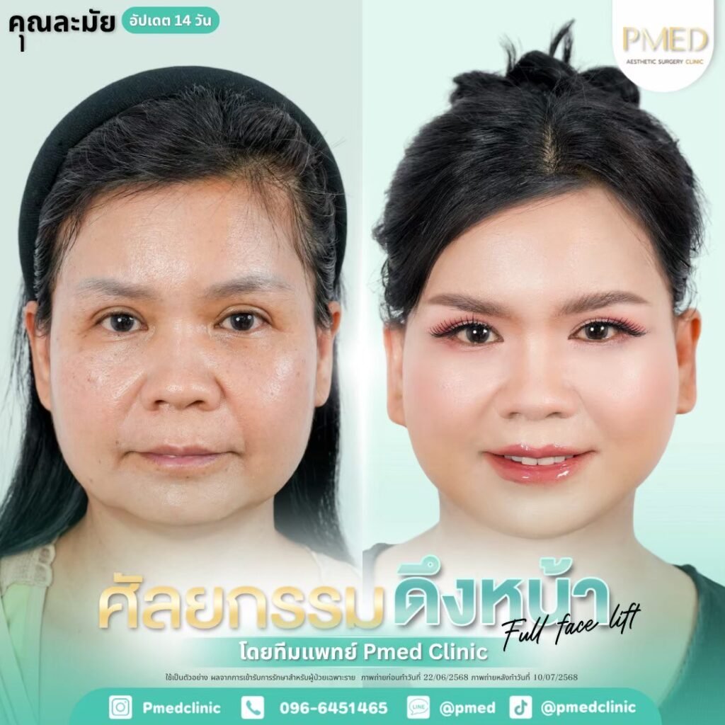 LINE ALBUM ดึงหน้า Full Face Lift 260307 1