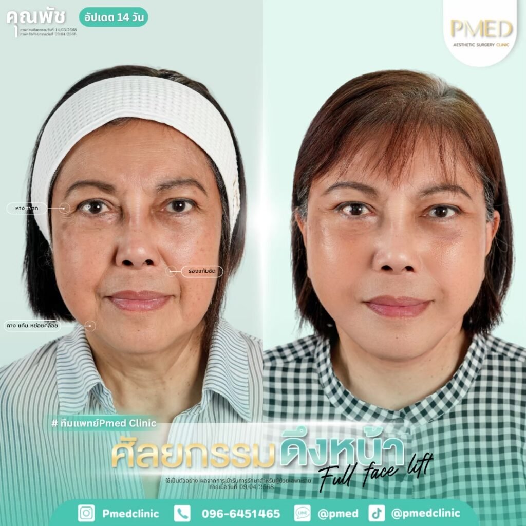 LINE ALBUM ดึงหน้า Full Face Lift 260307 2