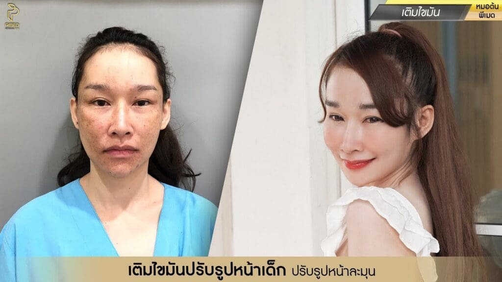เติมไขมันหลังดึงหน้าแก้ปัญหาผิวหย่อนคล้อยในวัย 50 ปีขึ้นไป คืนความอ่อนเยาว์อย่างเป็นธรรมชาติ