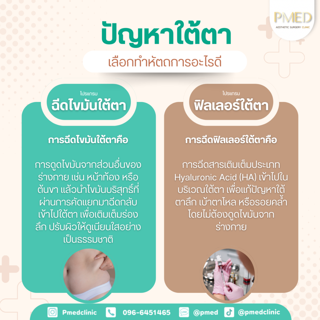 ฉีดไขมันใต้ตาคืออะไร ฉีดฟิลเลอร์ใต้ตาคืออะไร