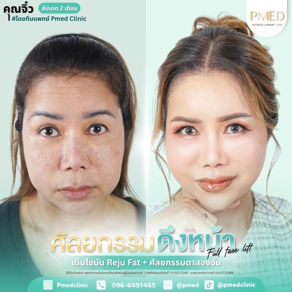 ดึงหน้า Full Face Lift 260307 1