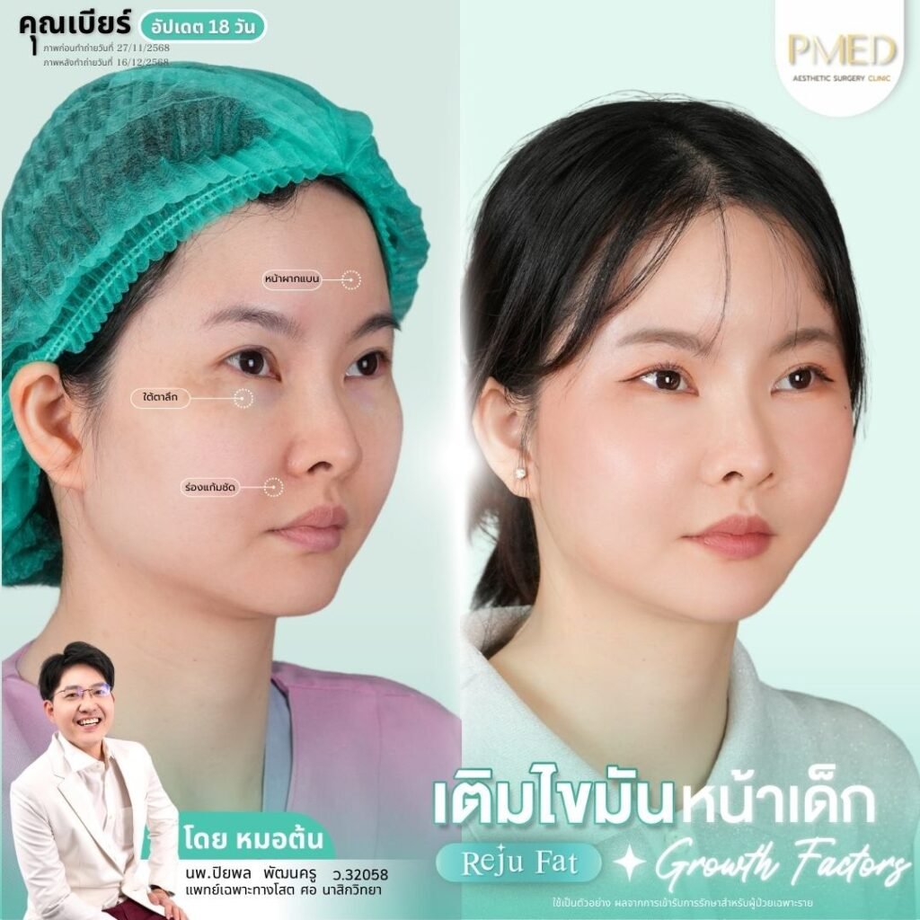 ฉีดไขมันใต้ตาคืออะไร? เทคนิคคืนความอ่อนเยาว์ให้ใบหน้าอย่างเป็นธรรมชาติ 6 เติมไขมัน Reju Fat ✨ 260305 1