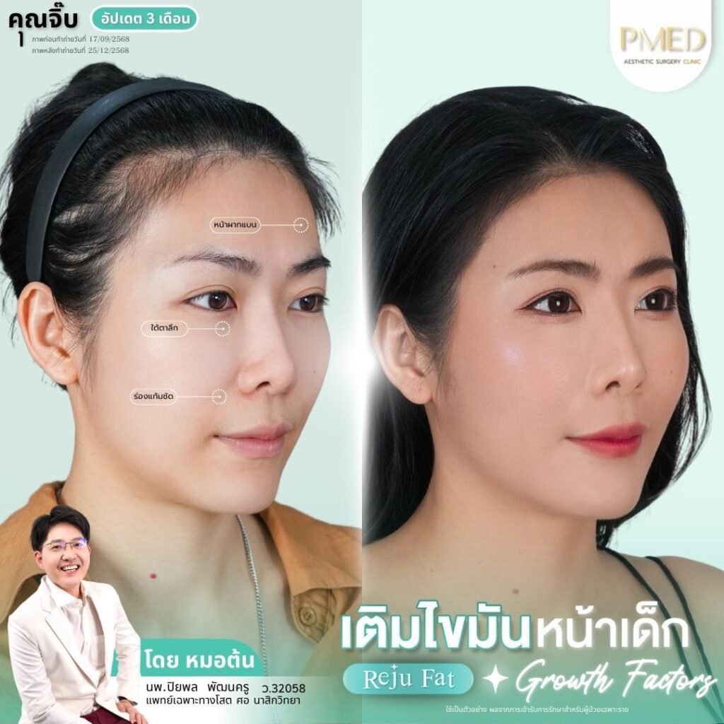 ฉีดไขมันใต้ตาคืออะไร? เทคนิคคืนความอ่อนเยาว์ให้ใบหน้าอย่างเป็นธรรมชาติ 7 เติมไขมัน Reju Fat ✨ 260305 2