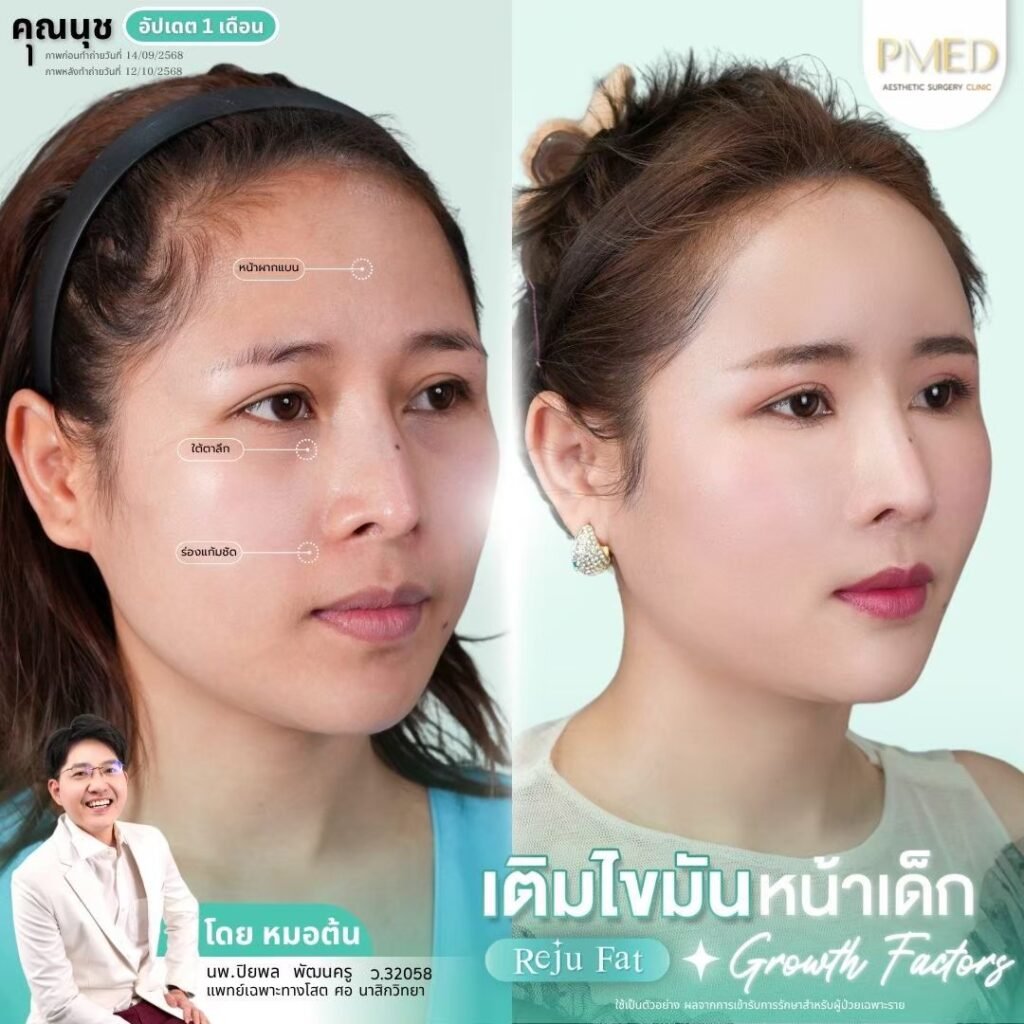 ฉีดไขมันใต้ตาคืออะไร? เทคนิคคืนความอ่อนเยาว์ให้ใบหน้าอย่างเป็นธรรมชาติ 8 เติมไขมัน Reju Fat ✨ 260305 3