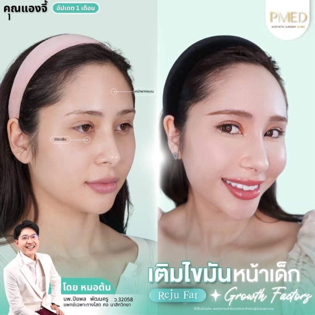 ฉีดไขมันใต้ตาคืออะไร? เทคนิคคืนความอ่อนเยาว์ให้ใบหน้าอย่างเป็นธรรมชาติ 5 เติมไขมัน Reju Fat ✨ 260305 4