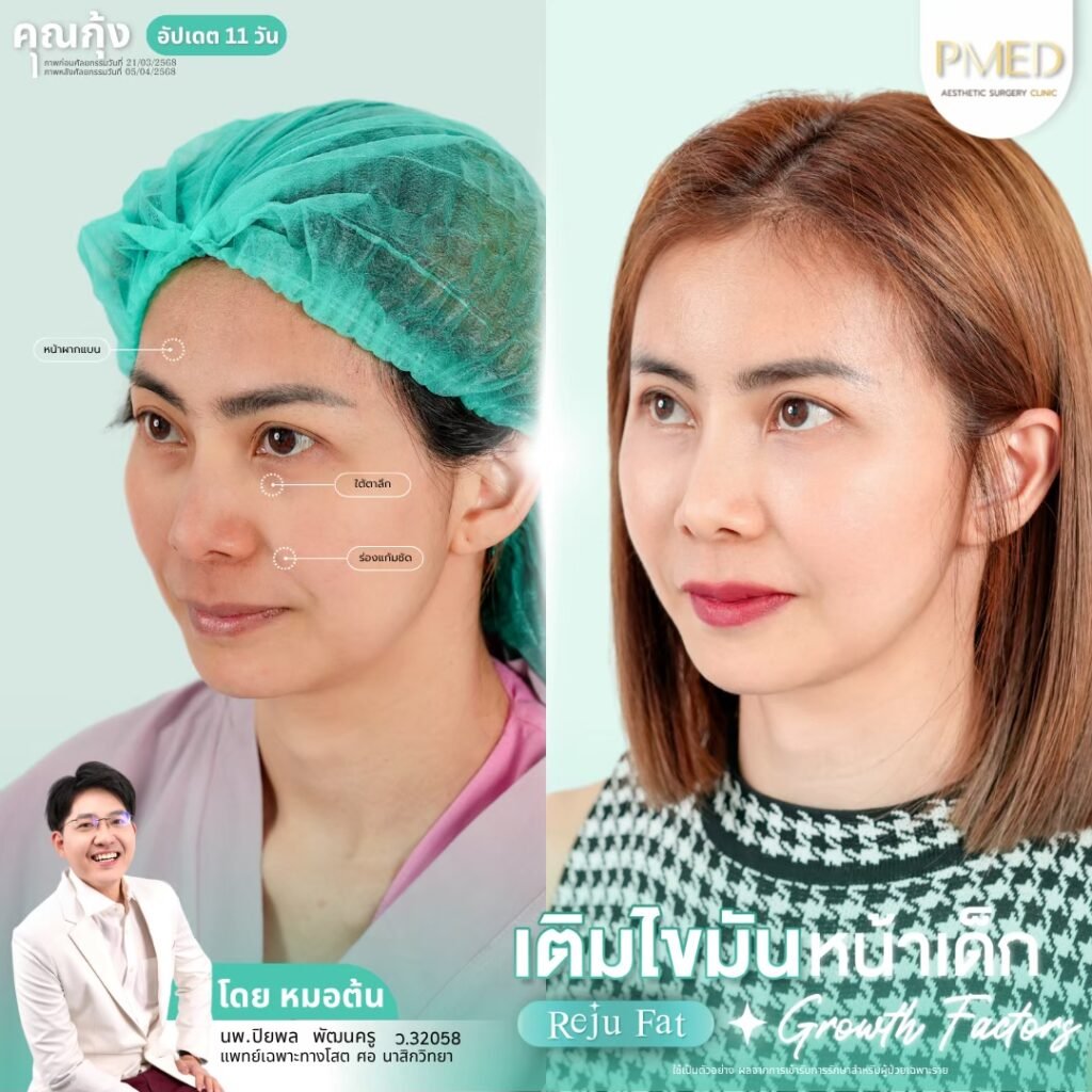 เติมไขมัน Reju Fat ✨ 260314 3