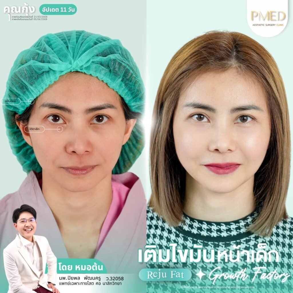 เติมไขมัน Reju Fat ✨ 260314 4