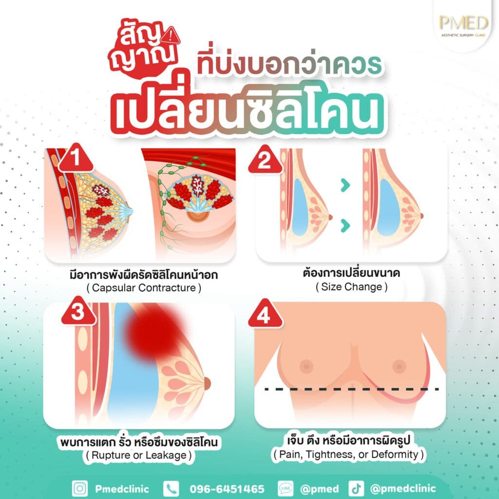 เปลี่ยนซิลิโคน TH PMED