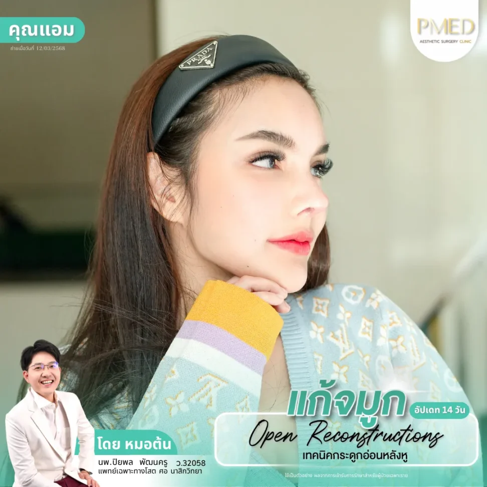 เจาะลึกทุกขั้นตอนเติมไขมันหน้าเพื่อผลลัพธ์ที่สวยเป็นธรรมชาติ 1 22_3_11zon