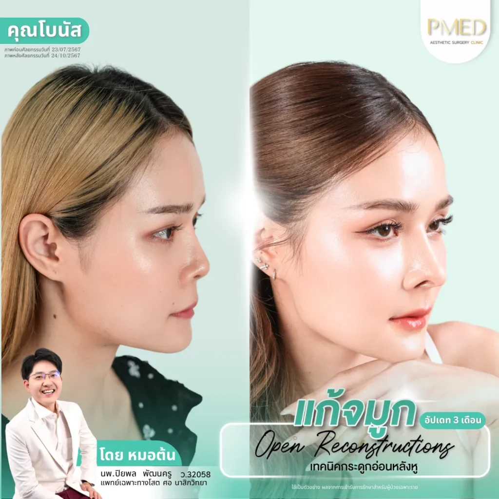 การแก้จมูกแบบโอเพ่นคืออะไร? ทางเลือกสำหรับคนที่อยากแก้จมูกอย่างเห็นผล 5 การแก้จมูกแบบโอเพ่นคืออะไร? ทางเลือกสำหรับคนที่อยากแก้จมูกอย่างเห็นผล
